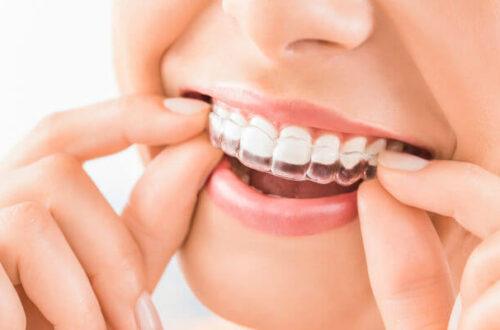 Clear Aligner Braces: A Modern Solution for Straighter Teeth 5 Invisalign 660x400 1